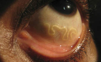 Eye with Parasitic Worm